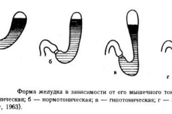 Формы желудка. Желудок серповидной формы.